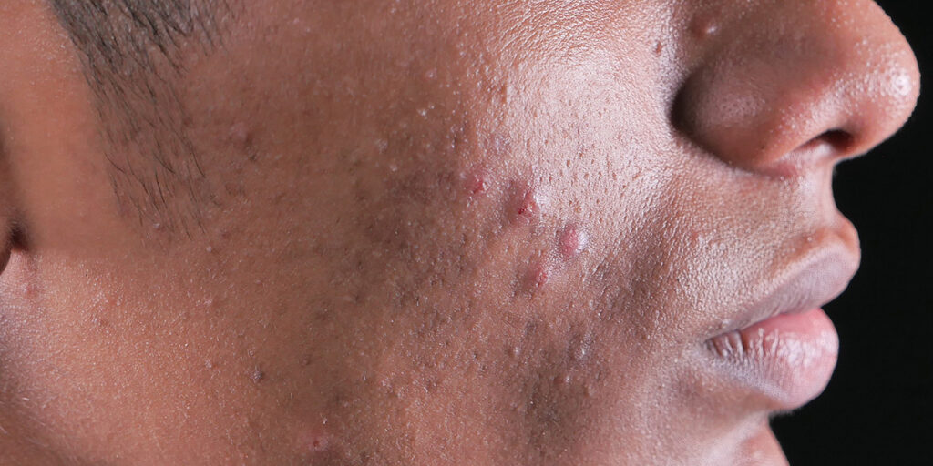 acne-what