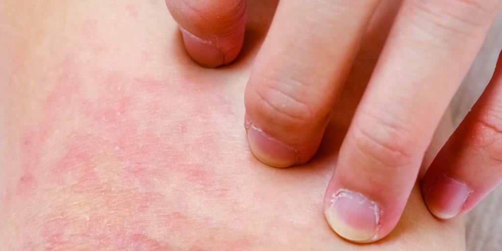 dermatitis-what dermatitis-what